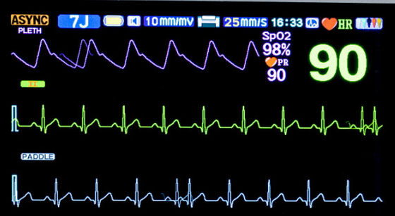 Biphasic Defibrillator Monitor Machine Medical Manual External Synchronous Asynchronous